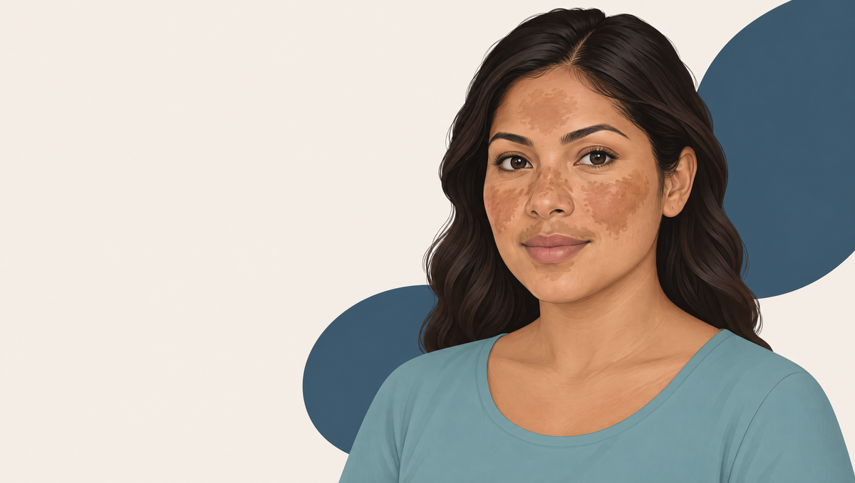 Illustration of a woman with medium-brown skin, with flat, blotchy brown patches on both cheeks, the bridge of her nose and her forehead.
